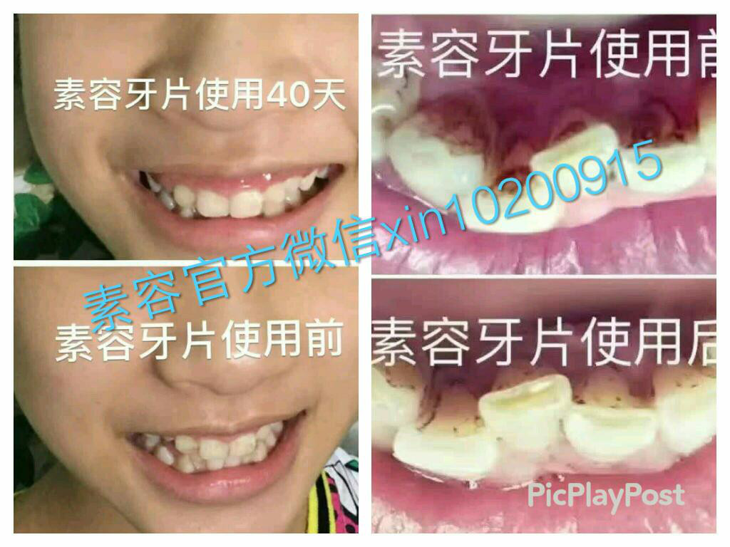 牙齿上有黄渍如何去除？牙齿发黄怎么办？
