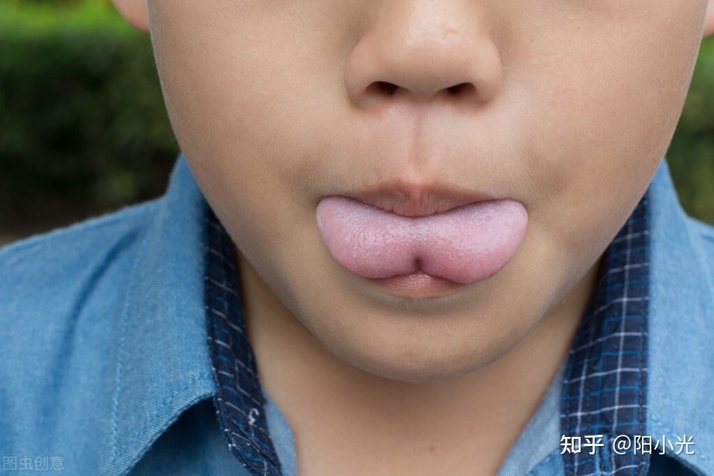 宝宝舌系带短手术过程(宝宝舌系带短手术后注意事项)