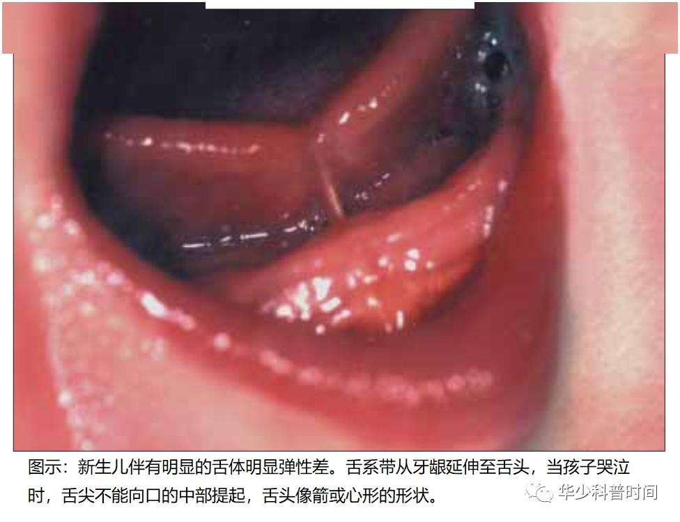宝宝舌系带短手术过程(宝宝舌系带短手术后注意事项)