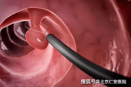 肠镜检查怎么做的过程视频(肠镜检查怎么做的过程视频讲解)
