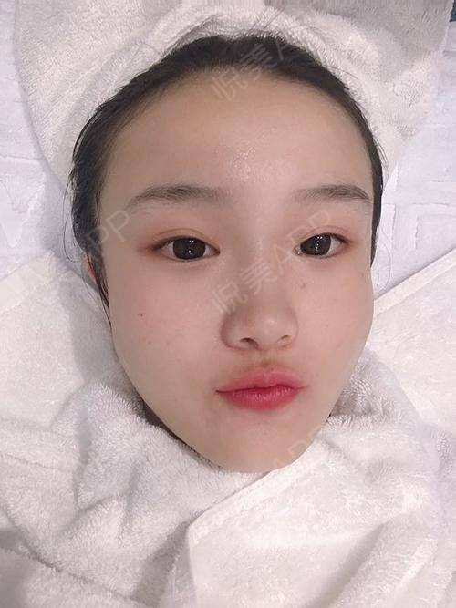 光子嫩肤怎么做视频(做光子嫩肤的全过程视频)